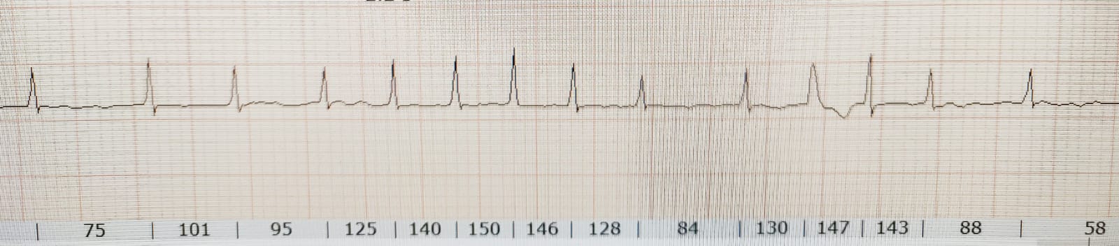 Esimerkki eteisv&auml;rist&auml; EKG-k&auml;yr&auml;ss&auml;.